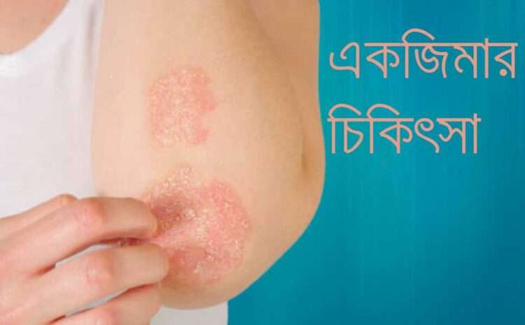 Homeopathy Treatment for Eczema
